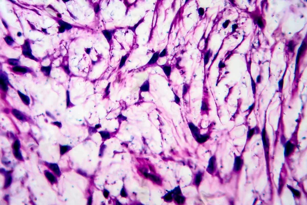 Cáncer Uterino Micrografía Ligera Foto Bajo Microscopio — Foto de Stock