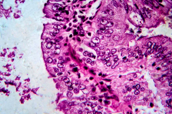 Adenocarcinoma Endométrio Micrografia Luz Foto Sob Microscópio — Fotografia de Stock