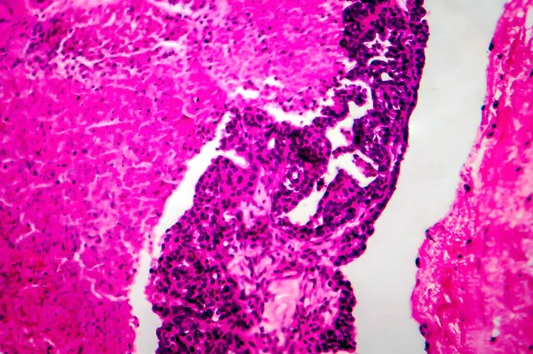 Papillary Serous Ovarian Adenocarcinoma Ovary Light Micrograph Photo Microscope — 스톡 사진