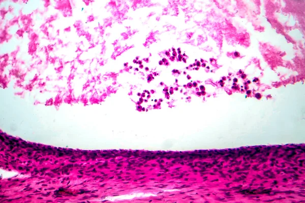 Ovarian mucinous cystadenoma, a benign tumor of ovary, light micrograph, photo under microscope