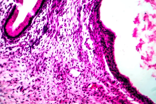 Ovarian mucinous cystadenoma, a benign tumor of ovary, light micrograph, photo under microscope