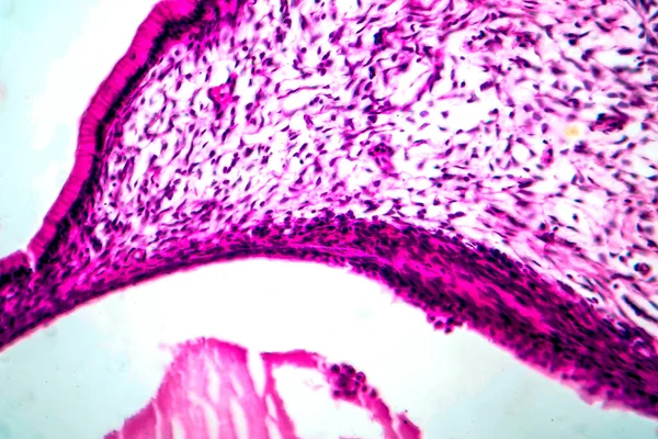 Citadenoma Mucinoso Ovárico Tumor Benigno Ovario Micrografía Ligera Foto Bajo — Foto de Stock