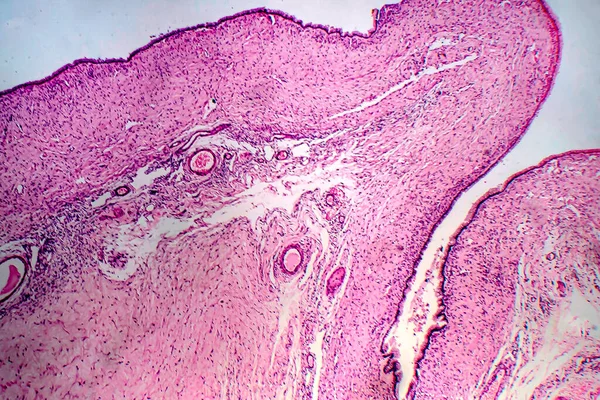 Ovarian Cyst Light Micrograph Photo Microscope — Stock Photo, Image