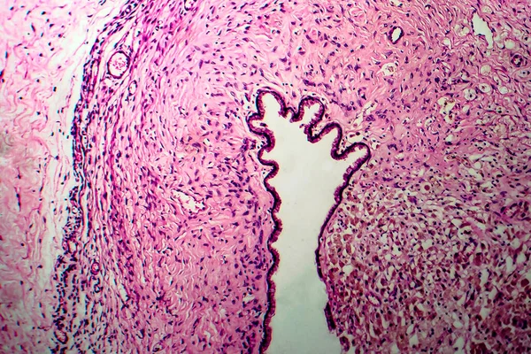 Quiste Ovárico Micrografía Ligera Foto Bajo Microscopio — Foto de Stock