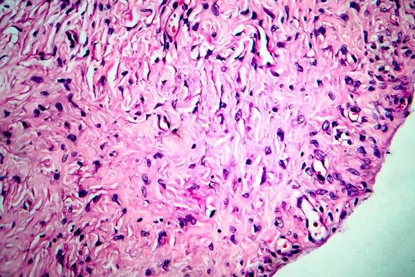 Ovariální Cysta Světelný Mikrograf Fotografie Pod Mikroskopem — Stock fotografie