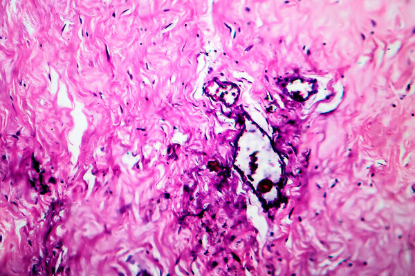 Breast fibroadenosis, light micrograph, photo under microscope. Common benign hyperplastic process involving breast glands