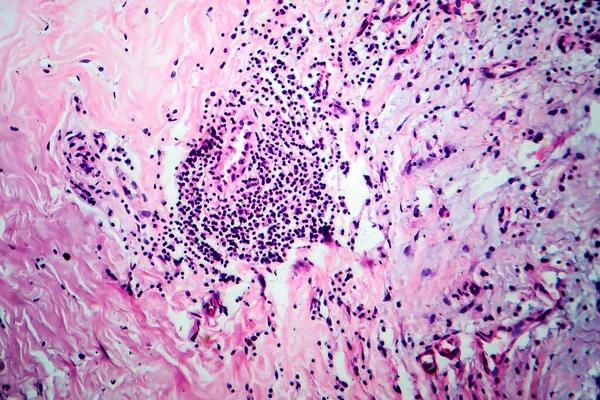 乳房線維症 軽いマイクログラフ 顕微鏡下の写真 乳房腺を含む一般的な良性の過形成過程 — ストック写真