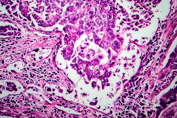 Carcinoma Ductal Mama Micrografia Luz Foto Sob Microscópio — Fotografia de Stock