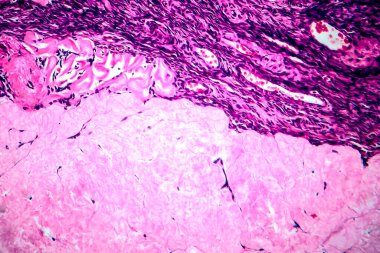 Yumurtalık foliküler kisti, hafif mikrograf, mikroskop altında fotoğraf.