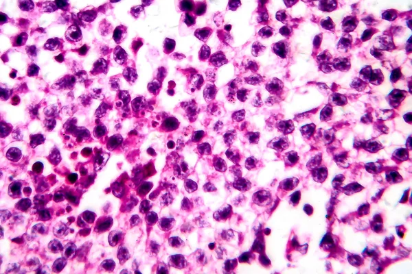 Seminoma Testicular Micrografía Ligera Foto Bajo Microscopio Tumor Células Germinativas — Foto de Stock