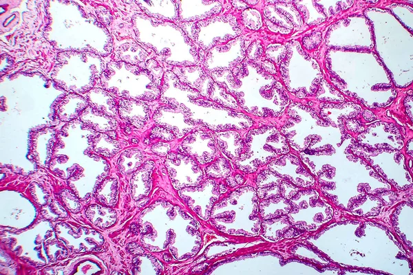 Prostaatkanker Lichtmicrograaf Foto Onder Microscoop — Stockfoto