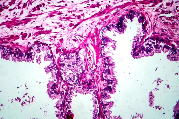 Prostaatkanker Lichtmicrograaf Foto Onder Microscoop — Stockfoto