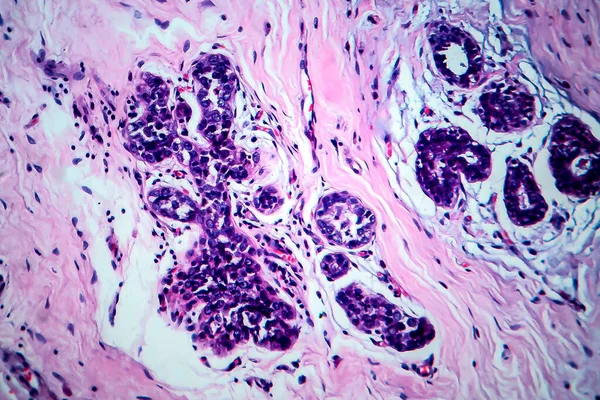 Breast Cancer Light Micrograph Photo Microscope — Stock Photo, Image