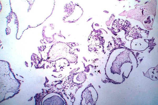 Hydatiform Anyajegy Fény Mikrográf Terhességi Trofoblasztos Betegség Kóros Chorion Villi — Stock Fotó