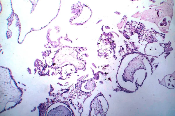 Гідроформальний Моль Легкий Мікрограф Гестаційна Трофобластична Хвороба Аномальними Хоріонічними Лиходіями — стокове фото