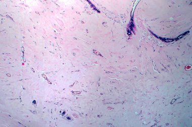 Rahimde adenofibroma, hafif mikrograf, mikroskop altında fotoğraf. Rahimde, salgı bezleri ve lifli dokulardan oluşan nadir bir iyi huylu tümör.