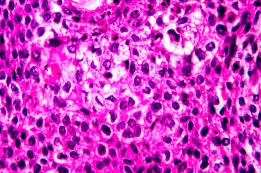 Rahmin skuamöz hücre kanseri, hafif mikrograf, mikroskop altında fotoğraf.