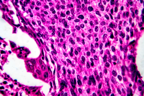 Spinocelulární Karcinom Dělohy Světelný Mikrograf Fotografie Pod Mikroskopem — Stock fotografie