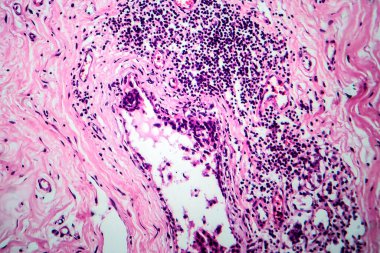 Göğüs fibrozisi, hafif mikrograf, mikroskop altında fotoğraf. Göğüs bezleri içeren yaygın iyi huylu hiperplastik işlem