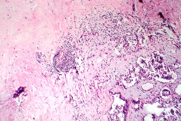 Breast Fibroadenosis Light Micrograph Photo Microscope Common Benign Hyperplastic Process — Stock Photo, Image