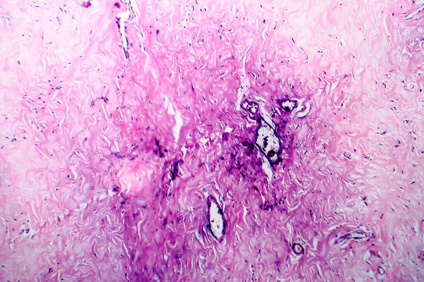 Breast fibroadenosis, light micrograph, photo under microscope. Common benign hyperplastic process involving breast glands