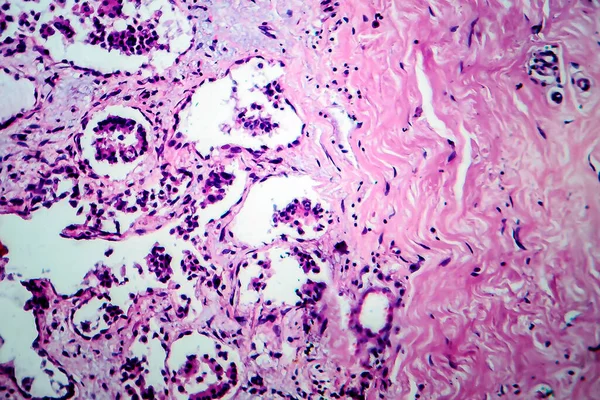 Fibroadenosis Mamaria Micrografía Ligera Foto Bajo Microscopio Proceso Hiperplástico Benigno —  Fotos de Stock