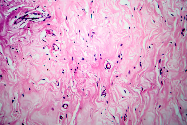 Breast fibroadenosis, light micrograph, photo under microscope. Common benign hyperplastic process involving breast glands