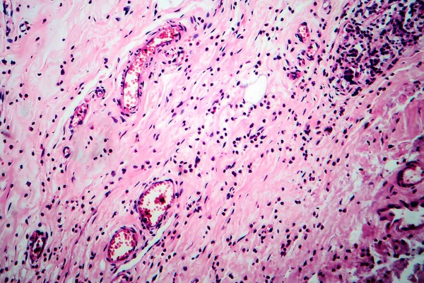 Breast fibroadenosis, light micrograph, photo under microscope. Common benign hyperplastic process involving breast glands