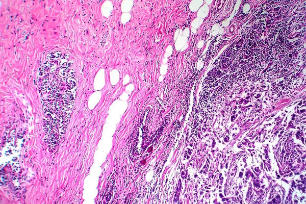Borstductaal Carcinoom Licht Micrograaf Foto Onder Microscoop — Stockfoto