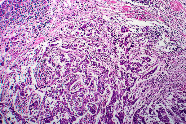 Breast ductal carcinoma, light micrograph, photo under microscope