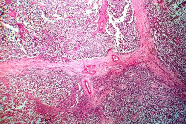Testis semineri, ışık mikrografı, mikroskop altında fotoğraf. Testisin en yaygın germ hücresi tümörü.