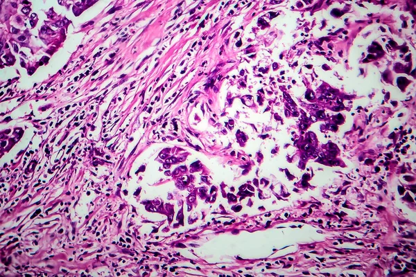 Carcinoma Ductal Mama Micrografia Luz Foto Sob Microscópio — Fotografia de Stock