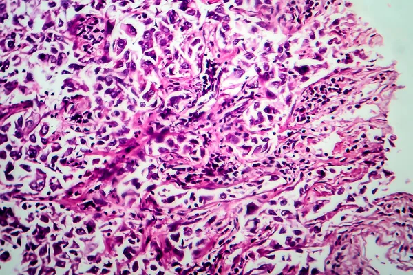 Breast Ductal Carcinoma Light Micrograph Photo Microscope — Stock Photo, Image