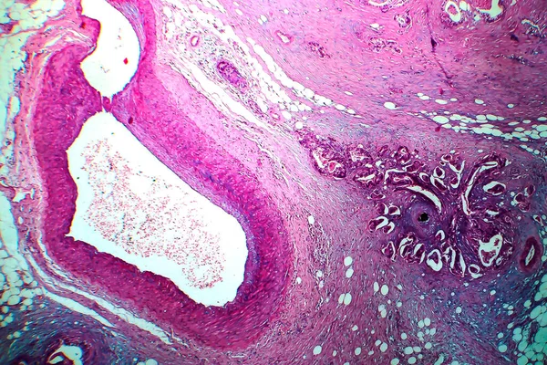 Borstkanker Lichtmicrograaf Foto Onder Microscoop — Stockfoto