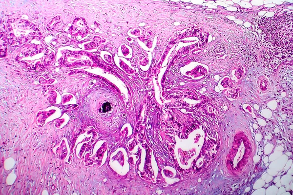 Câncer Mama Micrografia Luz Foto Sob Microscópio — Fotografia de Stock