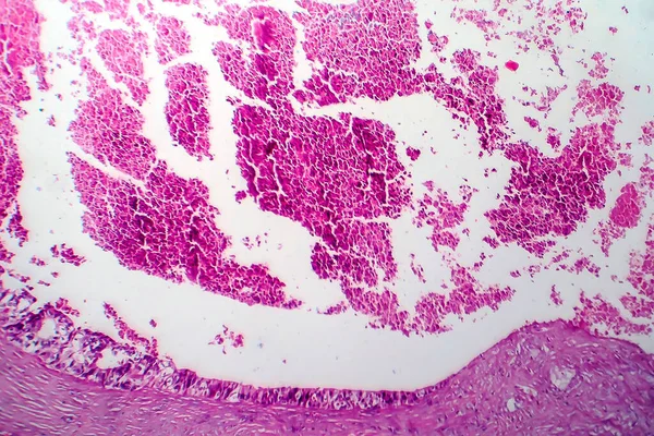 Rakovina Prsu Světelný Mikrograf Fotografie Pod Mikroskopem — Stock fotografie