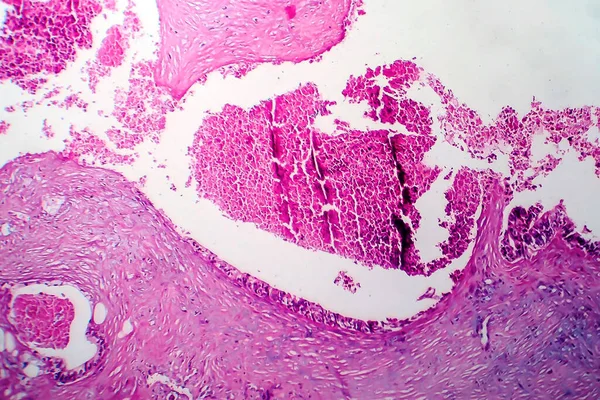 Câncer Mama Micrografia Luz Foto Sob Microscópio — Fotografia de Stock