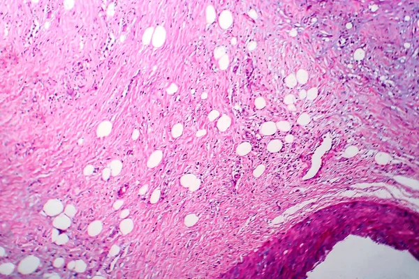 Borstkanker Lichtmicrograaf Foto Onder Microscoop — Stockfoto