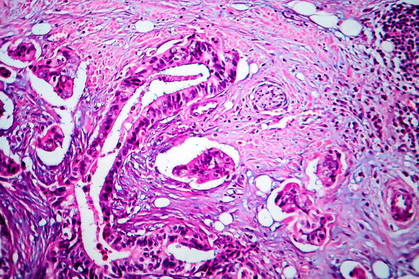 Breast cancer, light micrograph, photo under microscope