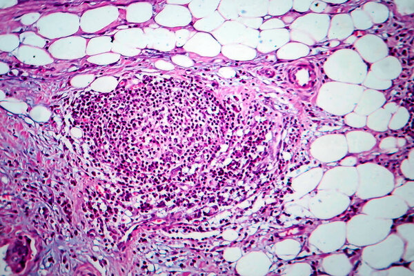 Breast cancer, light micrograph, photo under microscope