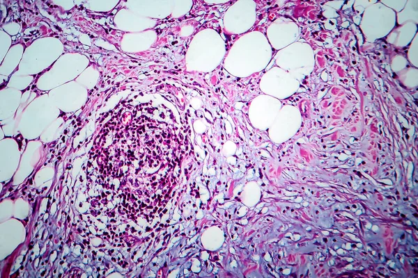 Kanker Payudara Mikrograf Cahaya Foto Bawah Mikroskop — Stok Foto
