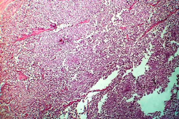 Seminoma Testicolare Micrografo Leggero Foto Microscopio Tumore Delle Cellule Germinali — Foto Stock