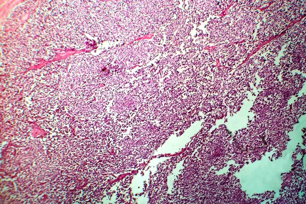 Séminome Testiculaire Micrographie Photonique Photo Microscope Une Tumeur Commune Des — Photo