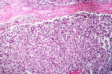 Testis semineri, ışık mikrografı, mikroskop altında fotoğraf. Testisin en yaygın germ hücresi tümörü.