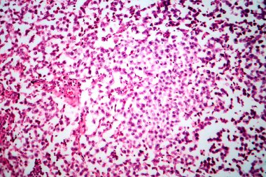 Testis semineri, ışık mikrografı, mikroskop altında fotoğraf. Testisin en yaygın germ hücresi tümörü.