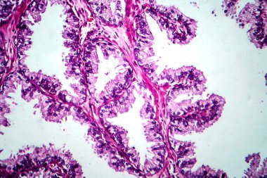 Prostat kanseri, ışık mikrografı, mikroskop altında fotoğraf.