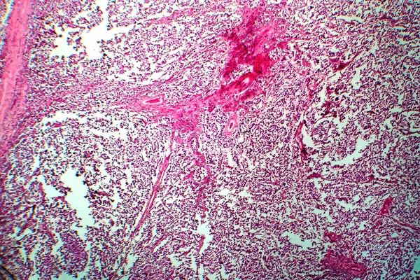 Seminoma Testicular Micrografia Luz Foto Sob Microscópio Tumor Células Germinativas — Fotografia de Stock