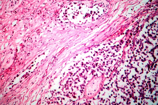睾丸精子瘤 显微镜下照片 睾丸最常见的生殖细胞瘤 — 图库照片