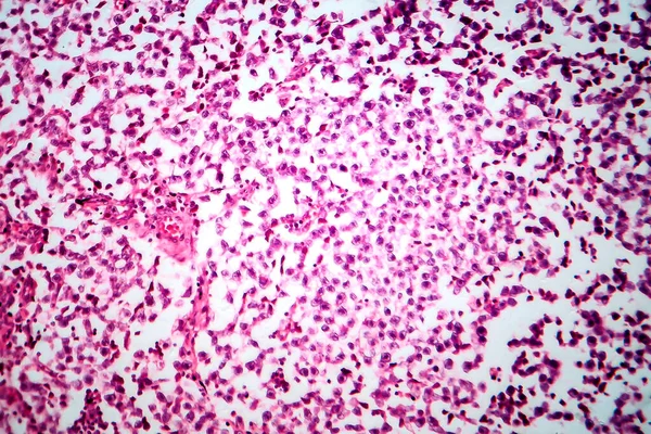 Seminoma Testicular Micrografía Ligera Foto Bajo Microscopio Tumor Células Germinativas — Foto de Stock