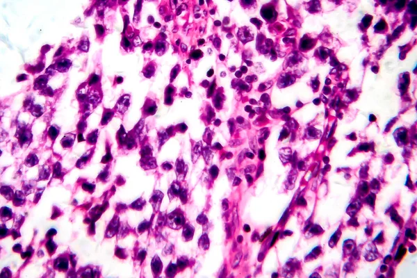 精巣セミノーマ 光マイクログラフ 顕微鏡下の写真 検査の最も一般的な生殖細胞腫瘍 — ストック写真